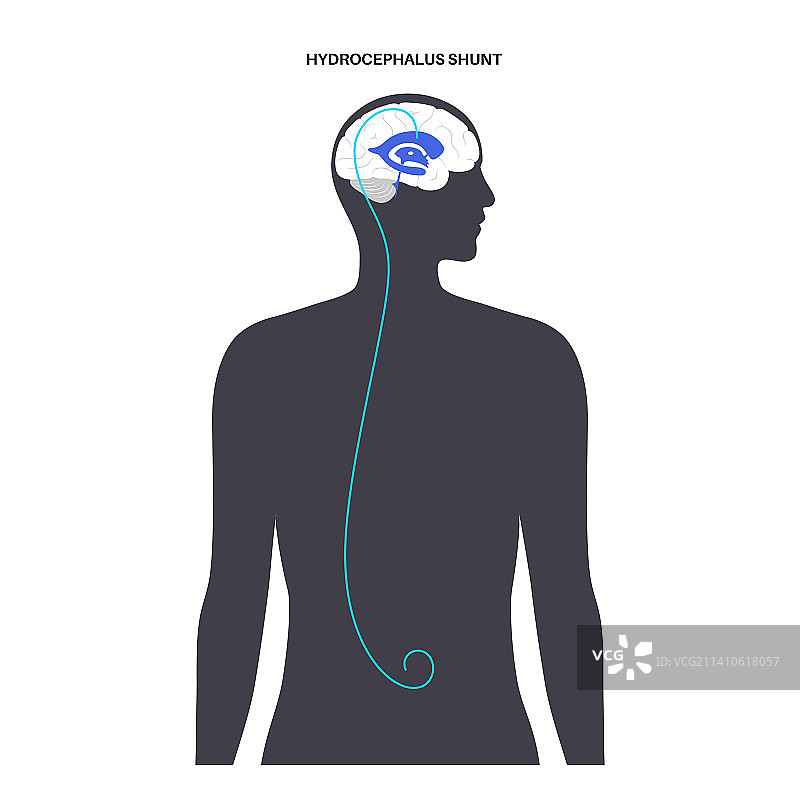 脑积水分流术插图图片素材
