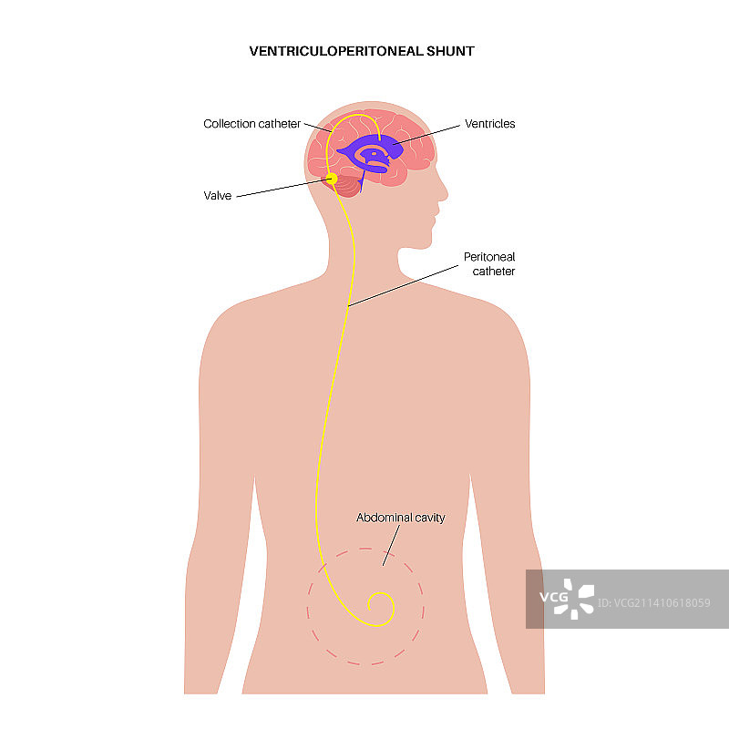 脑室腹腔分流术插图图片素材