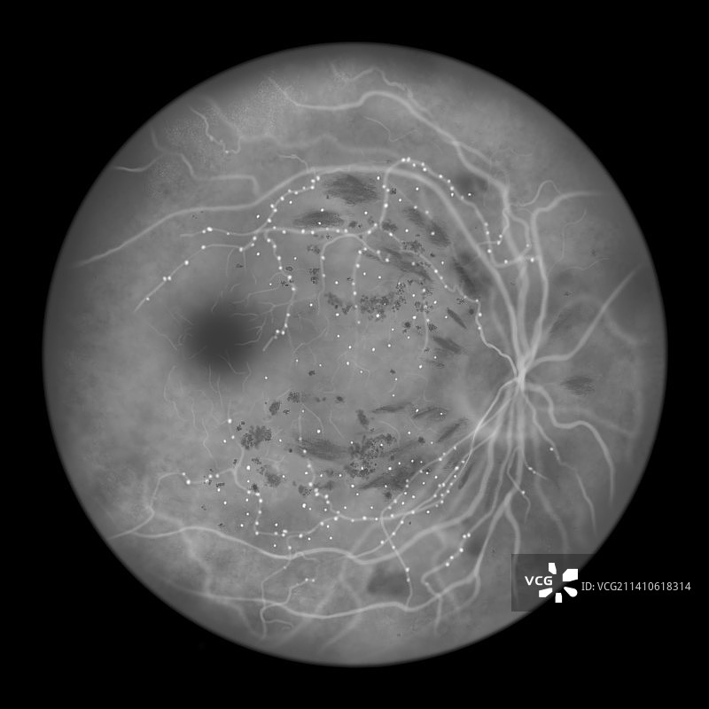 糖尿病引起的视网膜损伤，插图图片素材