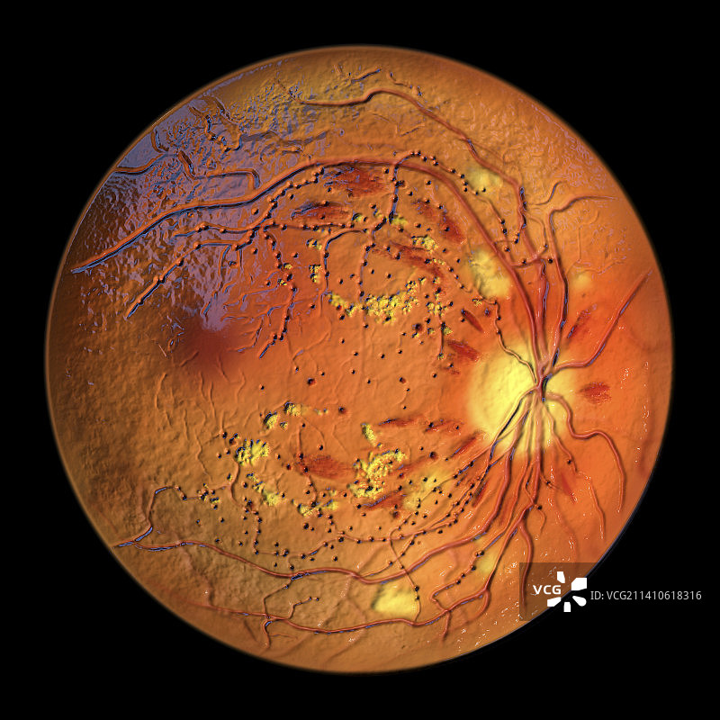 糖尿病引起的视网膜损伤，插图图片素材