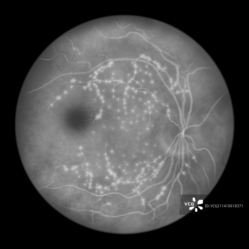 糖尿病引起的视网膜损伤，插图图片素材