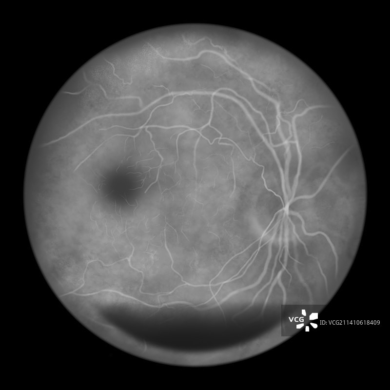 糖尿病引起的视网膜损伤，插图图片素材