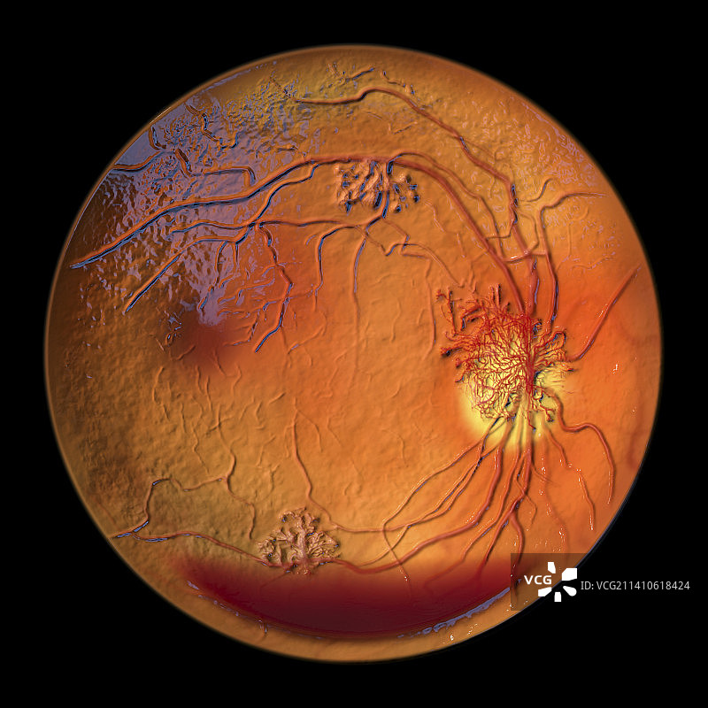 糖尿病引起的视网膜损伤，插图图片素材