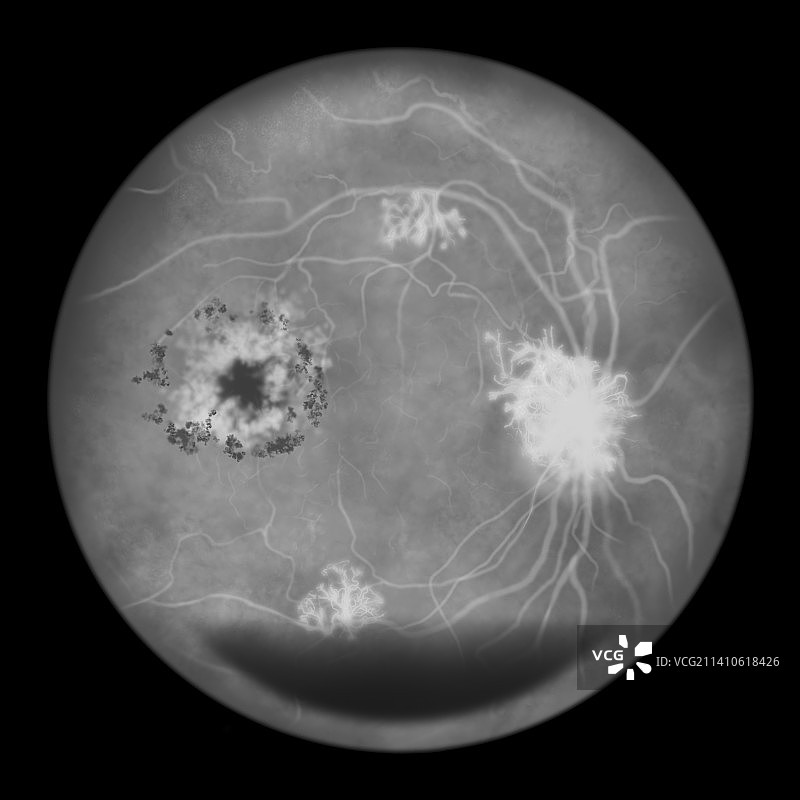 糖尿病引起的视网膜损伤，插图图片素材