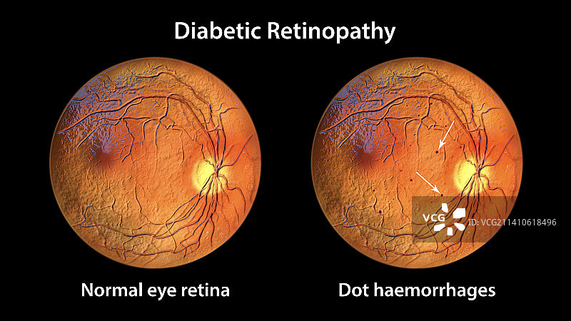 糖尿病引起的视网膜损伤，插图图片素材