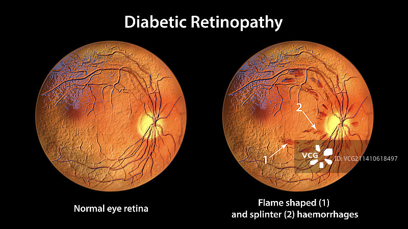 糖尿病引起的视网膜损伤，插图图片素材