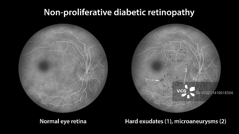 糖尿病引起的视网膜损伤，插图图片素材
