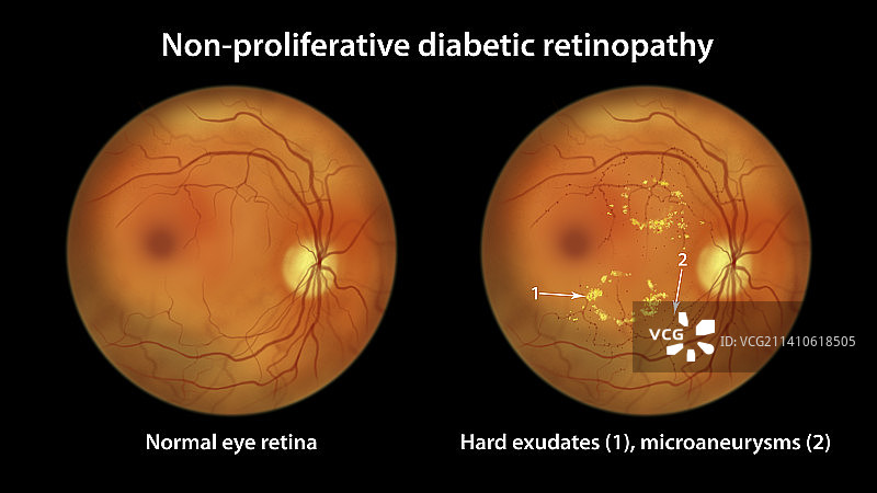糖尿病引起的视网膜损伤，插图图片素材