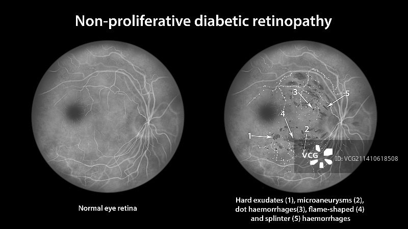 糖尿病引起的视网膜损伤，插图图片素材
