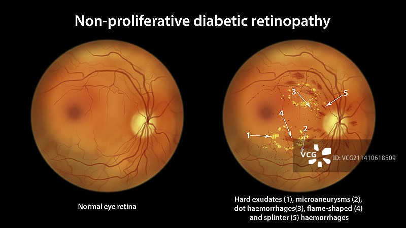 糖尿病引起的视网膜损伤，插图图片素材