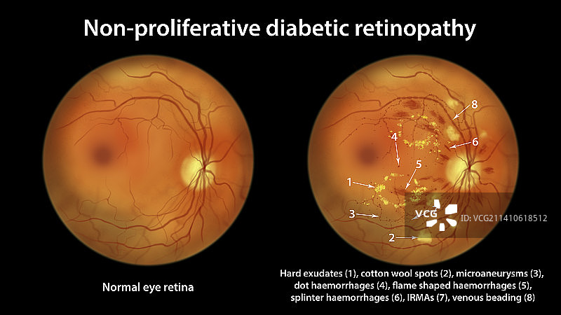 糖尿病引起的视网膜损伤，插图图片素材