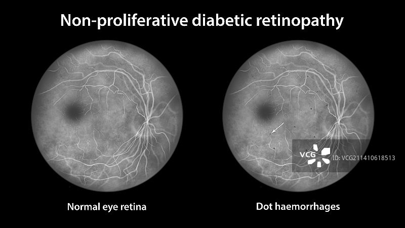 糖尿病引起的视网膜损伤，插图图片素材