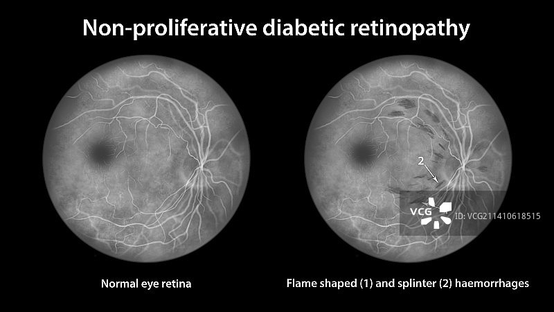 糖尿病引起的视网膜损伤，插图图片素材