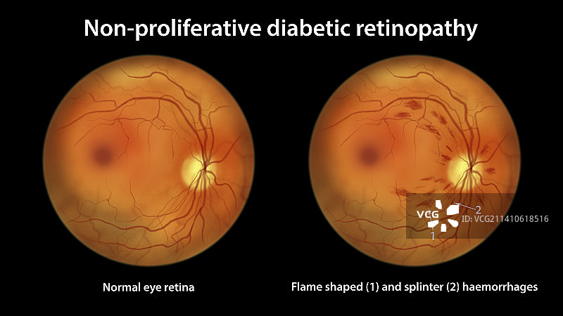 糖尿病引起的视网膜损伤，插图图片素材