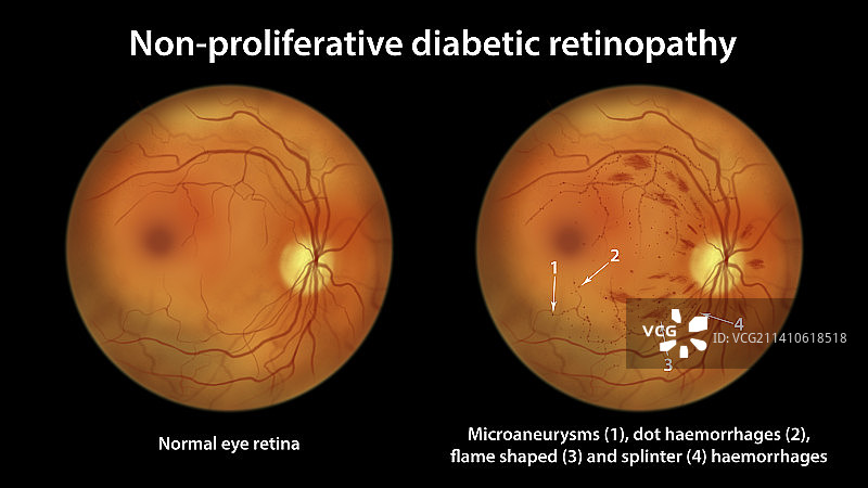 糖尿病引起的视网膜损伤，插图图片素材