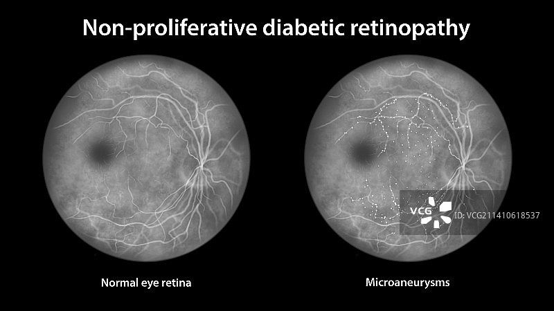 糖尿病引起的视网膜损伤，插图图片素材