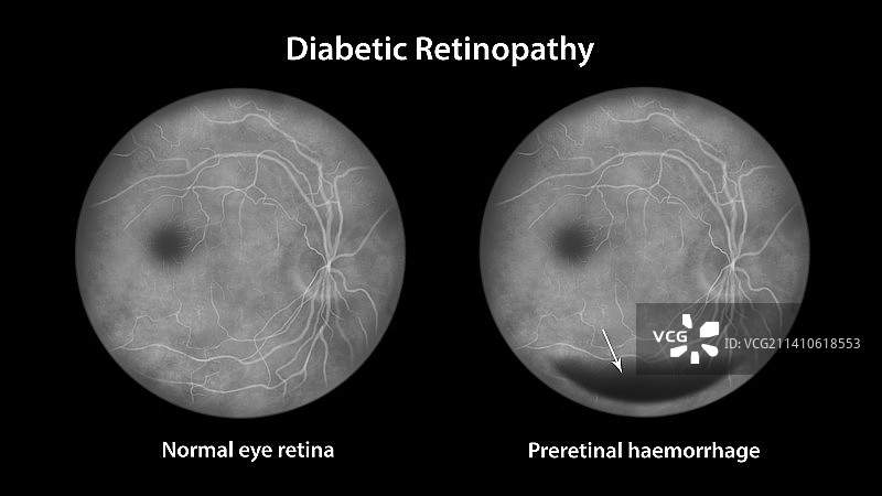 糖尿病引起的视网膜损伤，插图图片素材