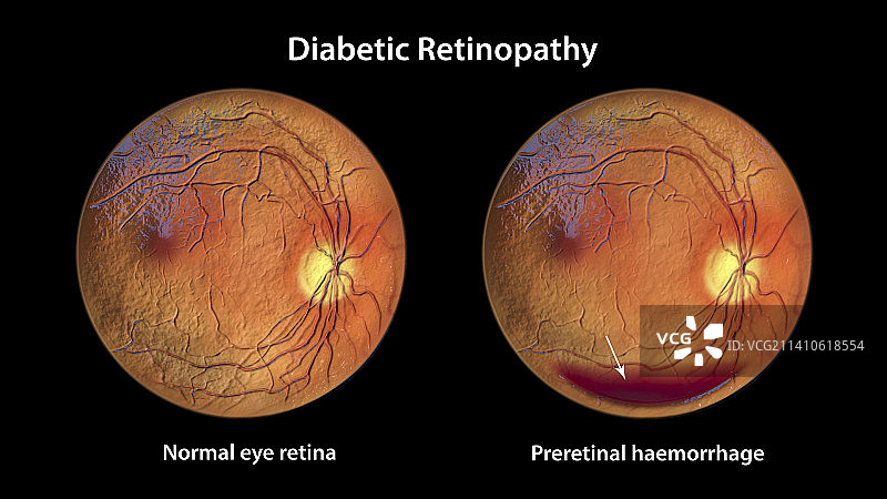 糖尿病引起的视网膜损伤，插图图片素材