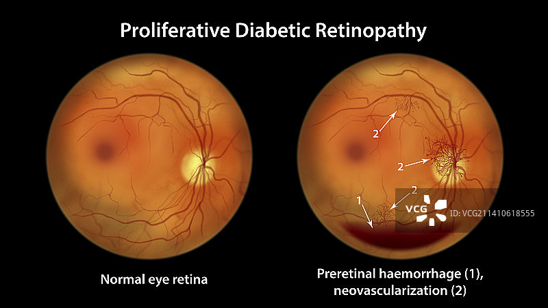 糖尿病引起的视网膜损伤，插图图片素材