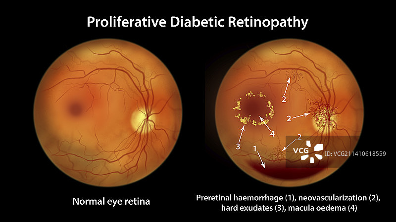 糖尿病引起的视网膜损伤，插图图片素材