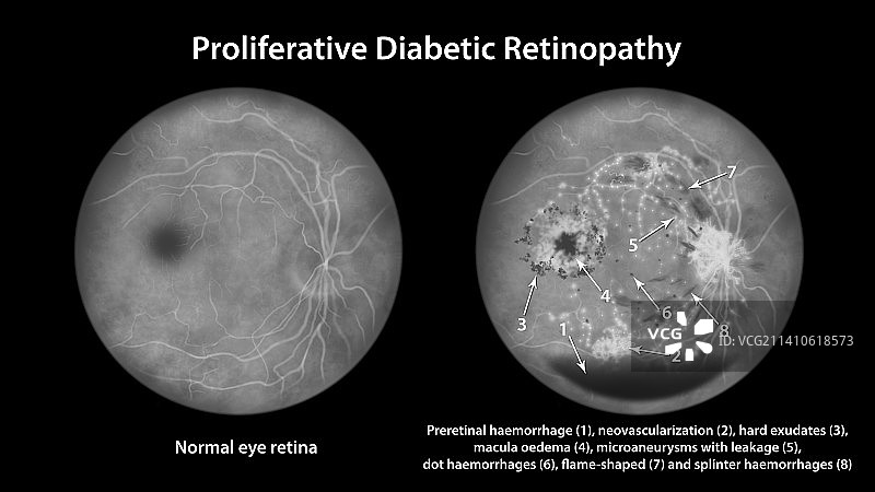 糖尿病引起的视网膜损伤，插图图片素材