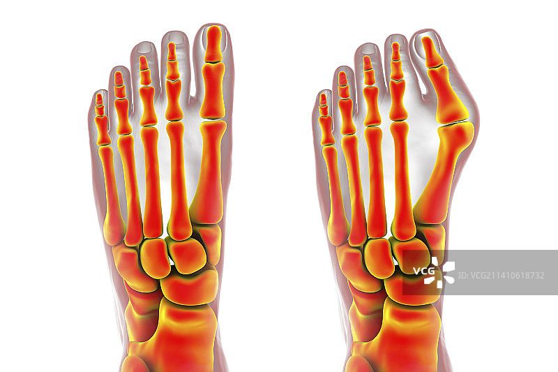 拇囊炎插图图片素材