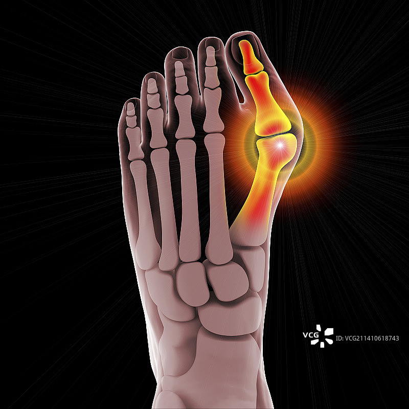 拇囊炎插图图片素材