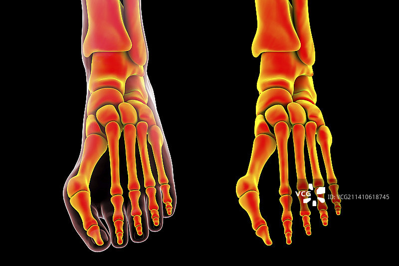 拇囊炎插图图片素材