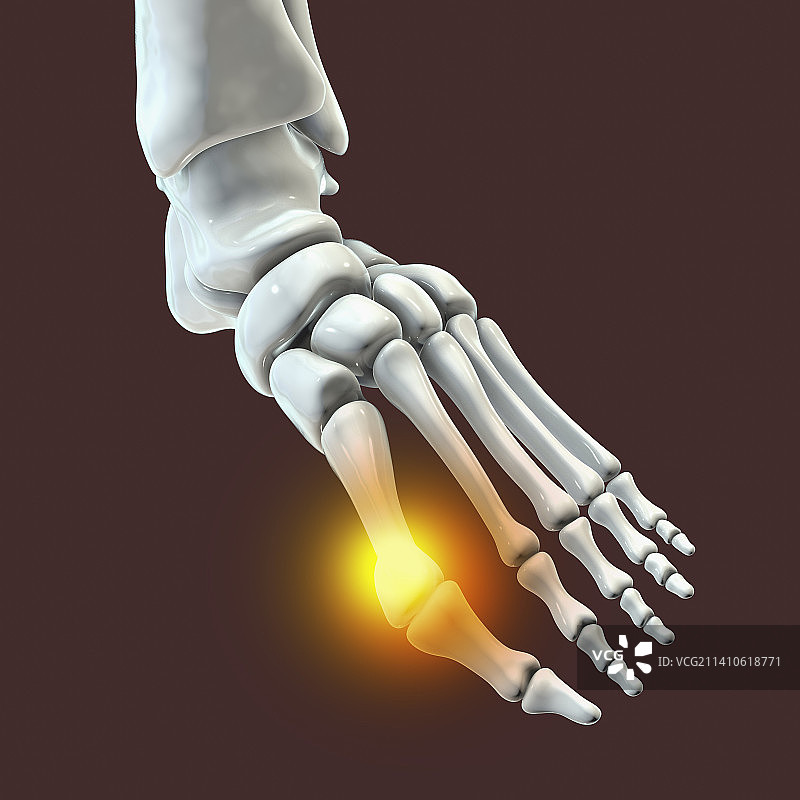 拇囊炎插图图片素材