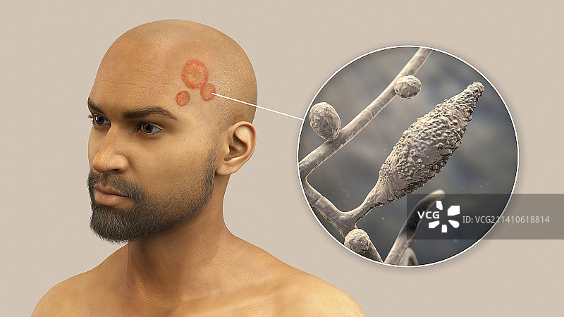 癣，图示图片素材
