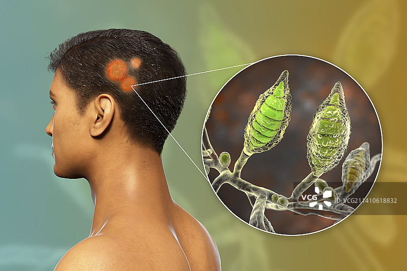 癣，图示图片素材