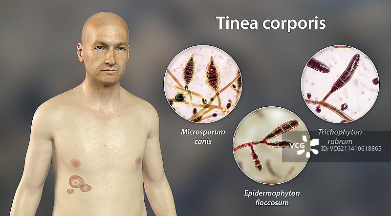 癣，图示图片素材