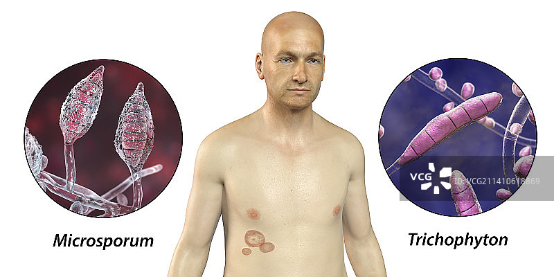 癣，图示图片素材