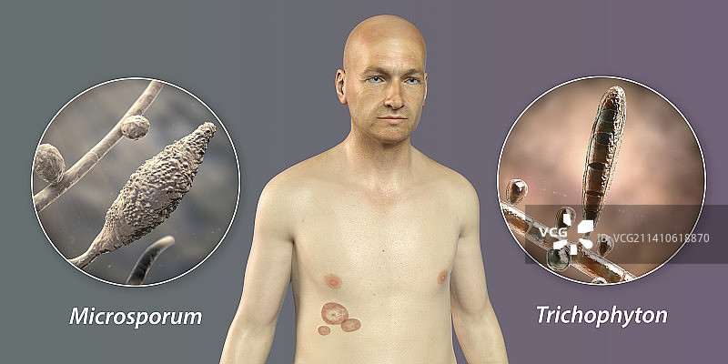 癣，图示图片素材