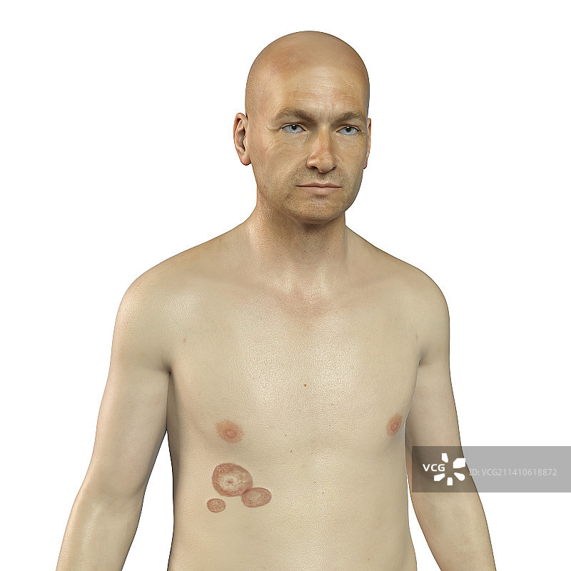 癣，图示图片素材