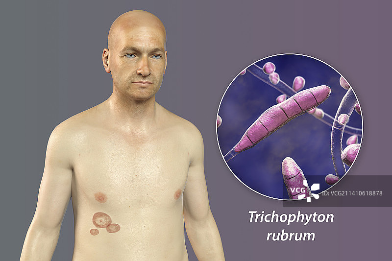 癣，图示图片素材