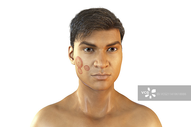 癣，图示图片素材