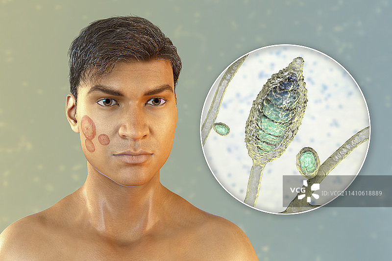 癣，图示图片素材