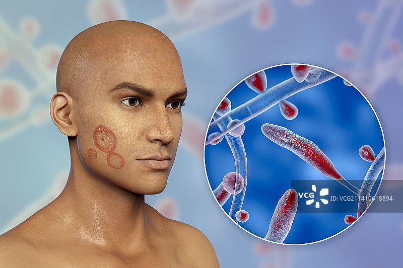 癣，图示图片素材