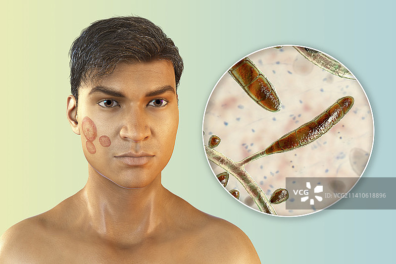 癣，图示图片素材