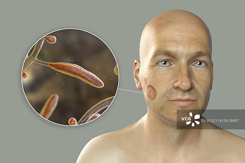 癣，图示图片素材