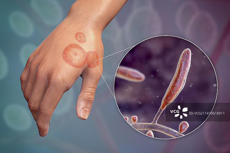 癣，图示图片素材