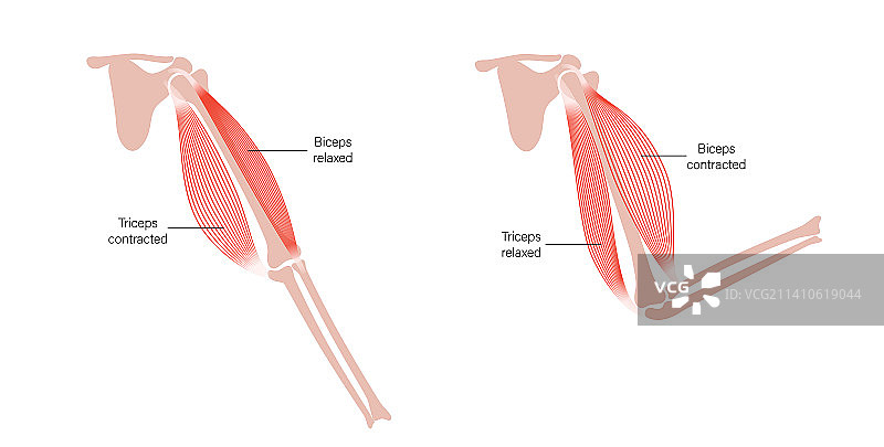 肌肉萎缩症插图图片素材