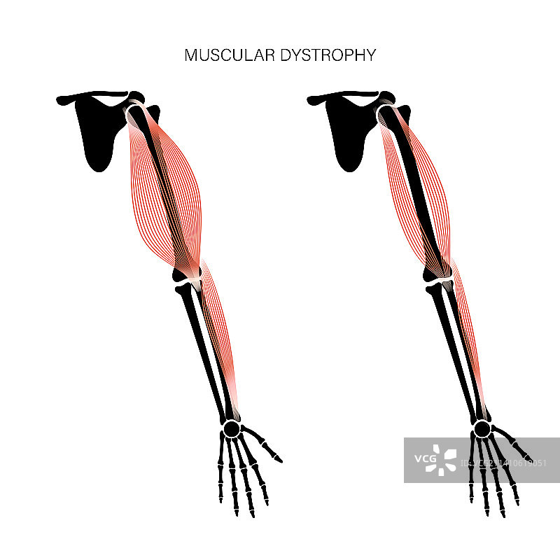肌肉萎缩症插图图片素材