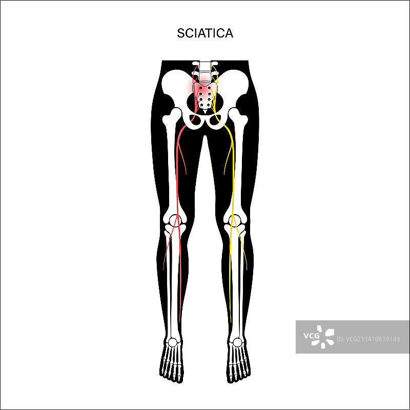 坐骨神经痛图示图片素材