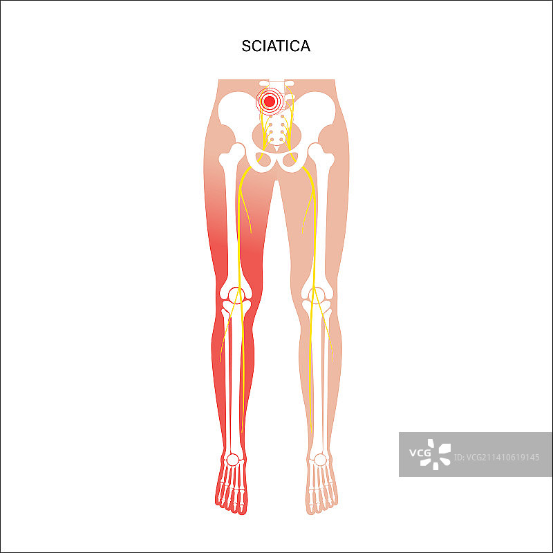 坐骨神经痛图示图片素材