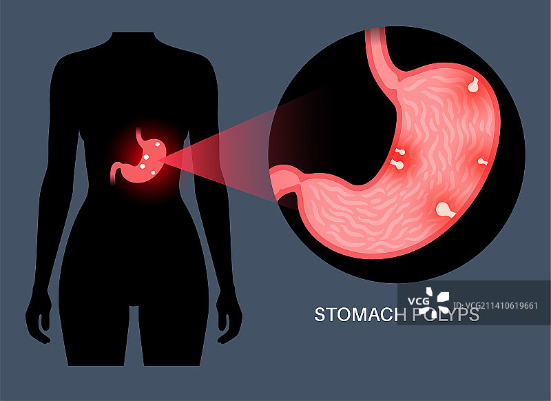胃息肉插图图片素材