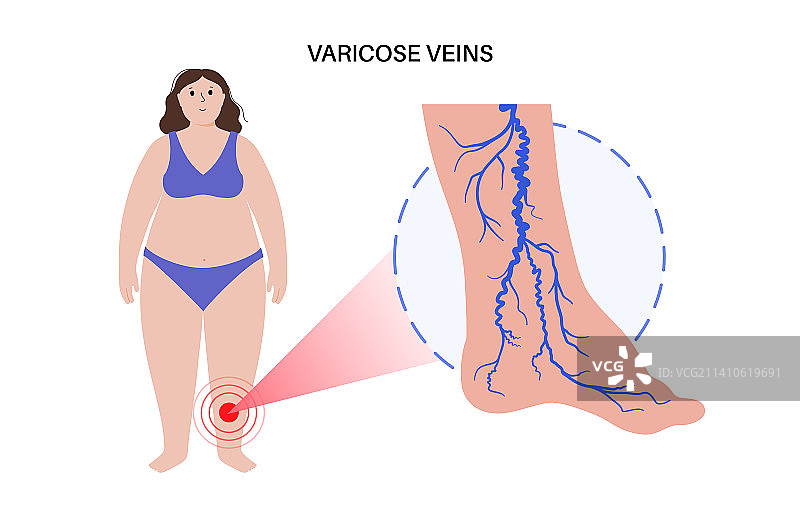 静脉曲张治疗图示图片素材