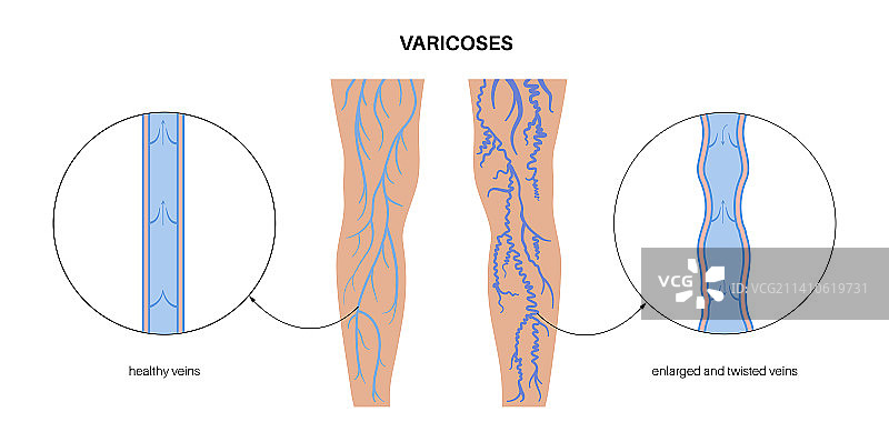 静脉曲张插图图片素材