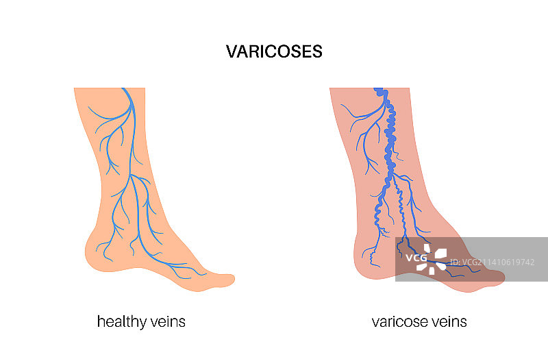静脉曲张插图图片素材